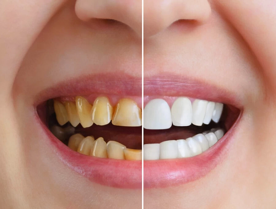 Teeth Whitening Teeth Whitening