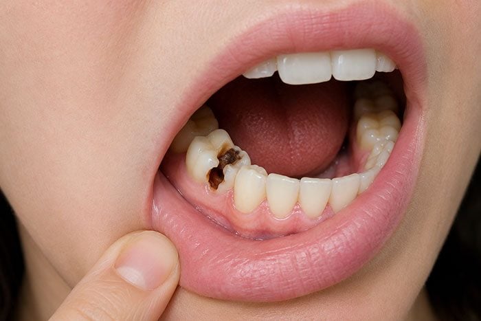 Close-up of an open mouth showing a decayed molar