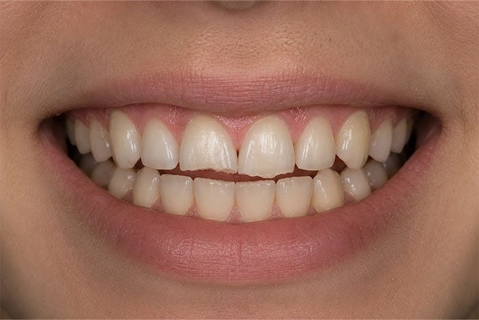 Cosmetic-Composite-Bonding-Path-before Cosmetic-Composite-Bonding-Path-before