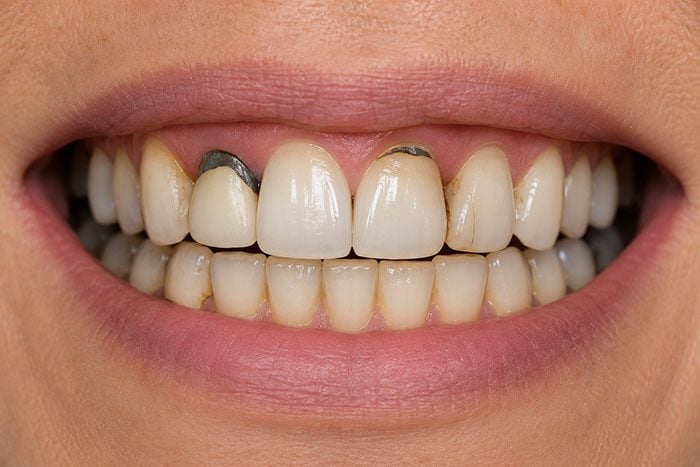 Close-up of a smile showing worn teeth and old metal fillings