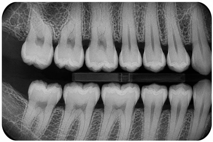 Bitewing dental X-ray showing the upper and lower back teeth