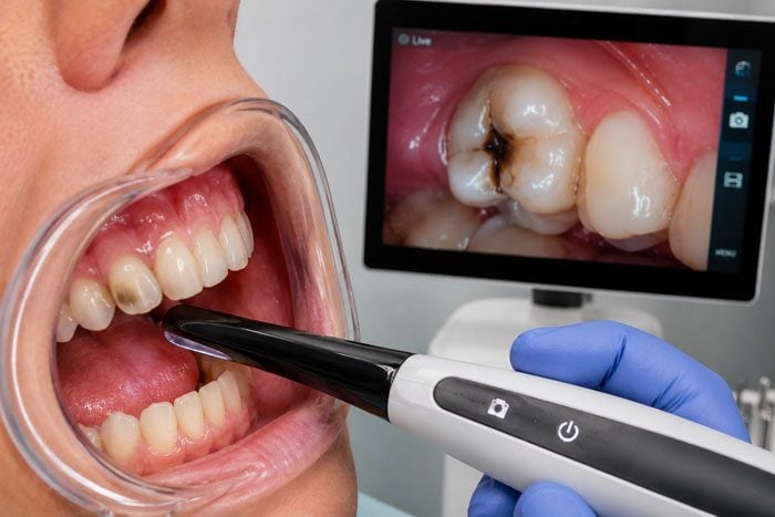 An intraoral camera in use, with the image of the tooth shown on a screen