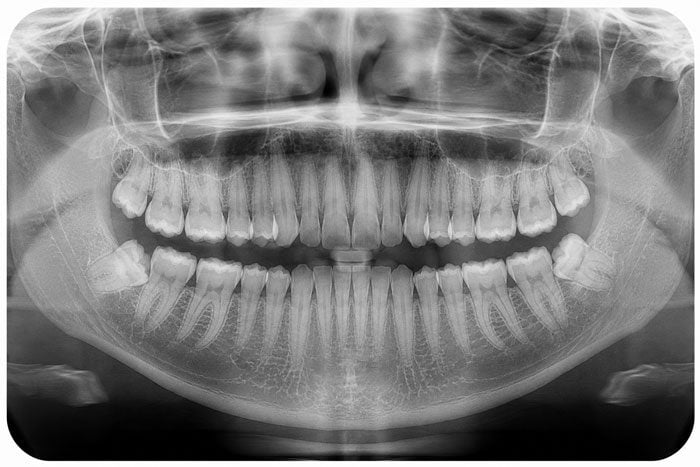 Panoramic dental X-ray of the upper and lower jaw