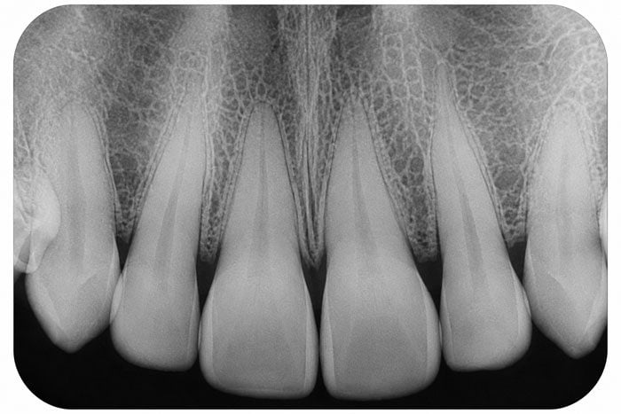 Periapical dental X-ray showing the roots of the upper teeth