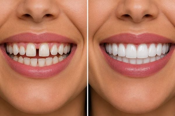Before and after comparison of a smile, showing a gap between the front teeth closed